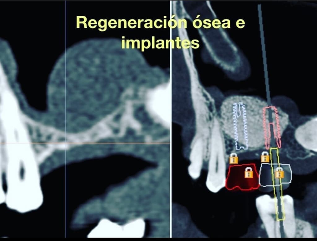 Trabajos de implantes en Álvarez Uriarte & Cameselle