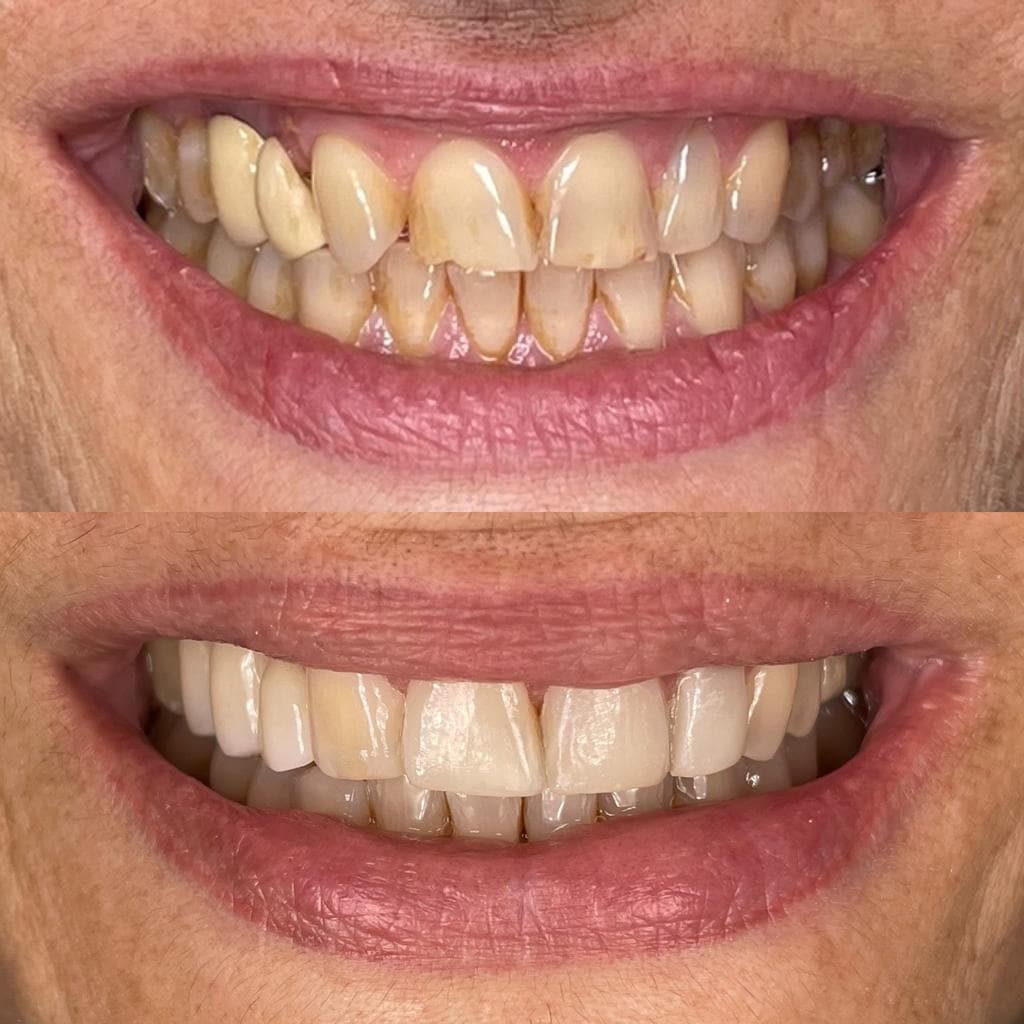 Trabajos de estética dental en Álvarez Uriarte & Cameselle