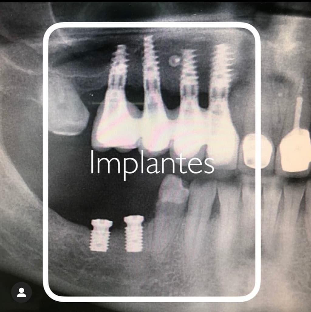 Trabajos de implantes en Álvarez Uriarte & Cameselle