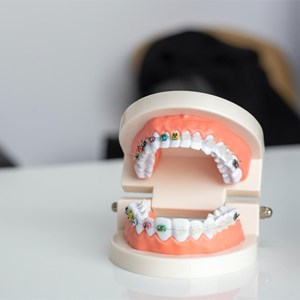 ¿Por qué es importante comenzar el tratamiento de ortodoncia en niños?